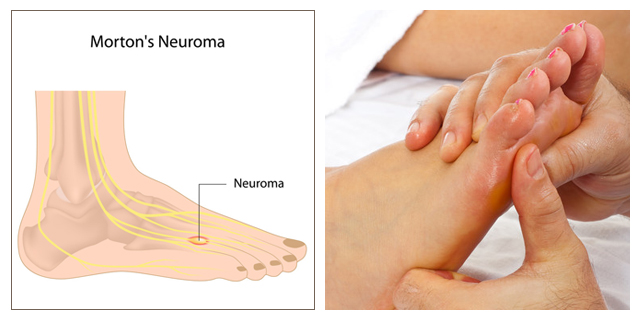 best new balance shoes for neuroma