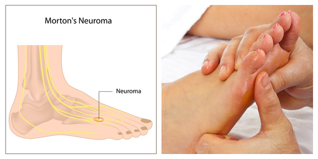 new balance for morton's neuroma